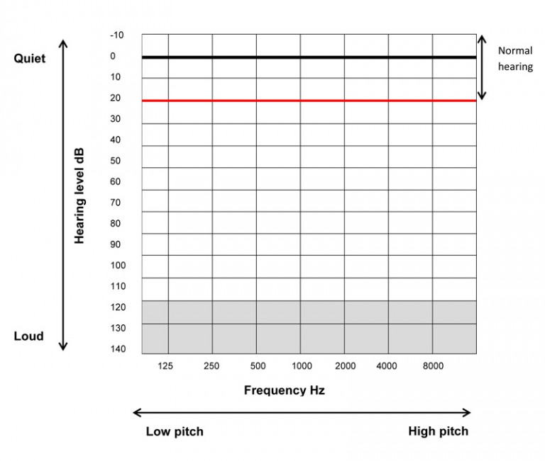 Audiogram example Audiometric Testing Perth